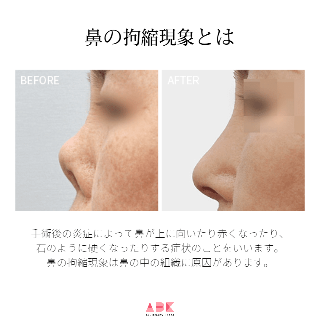 手術後の炎症によって鼻が上に向いたり赤くなったり、石のように硬くなったりする症状