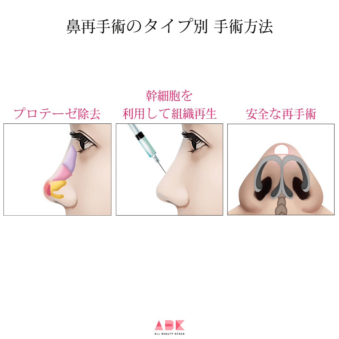 鼻再手術のタイプ別 手術方法
