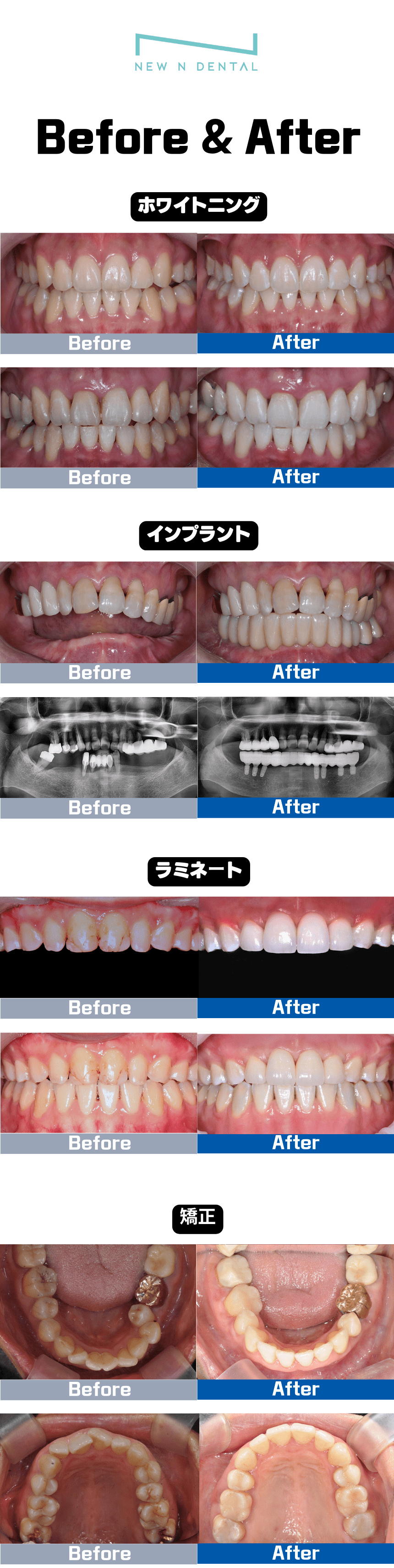 インプラント、ホワイトニング、矯正などの治療のBefore & Afterの結果。治療の効果を直接確認できます。