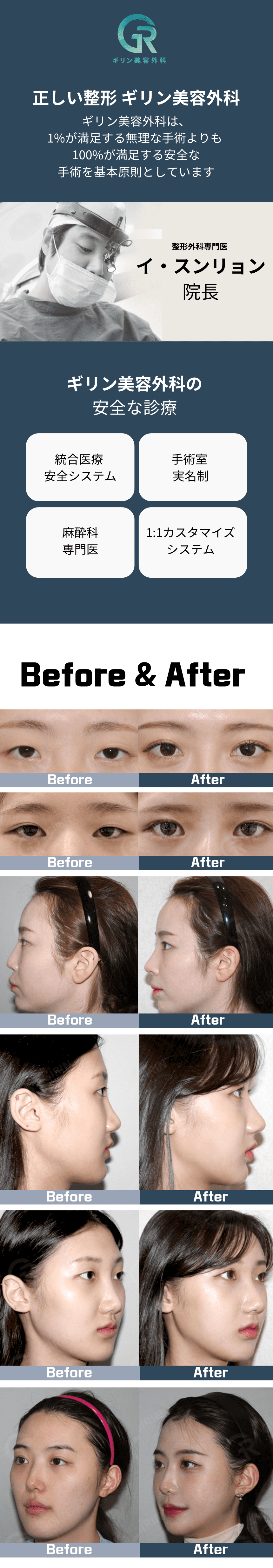 「Before & After」ギリン美容外科での手術前と手術後のビフォー・アフター画像。目と顔の輪郭の変化が表示されています。